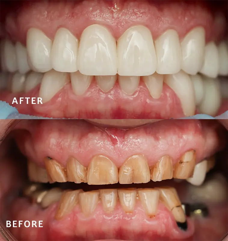 Before & After Full Smile Makeover Patient