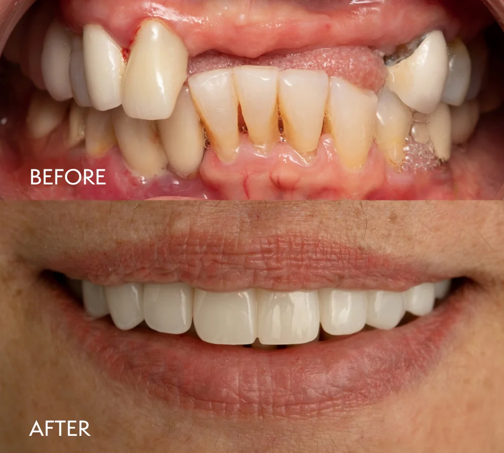 Dental Implants Before & After Patient Smile