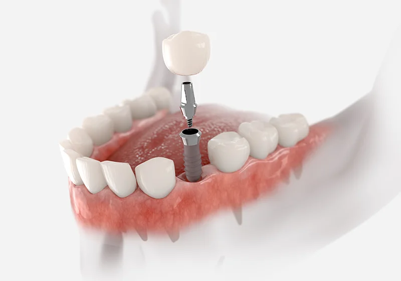 Dental Implants Illustration