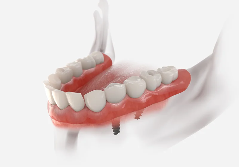Implant Supported Dentures Illustration