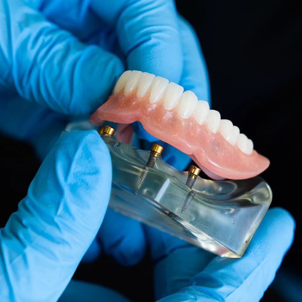 Implant Supported Dentures Model