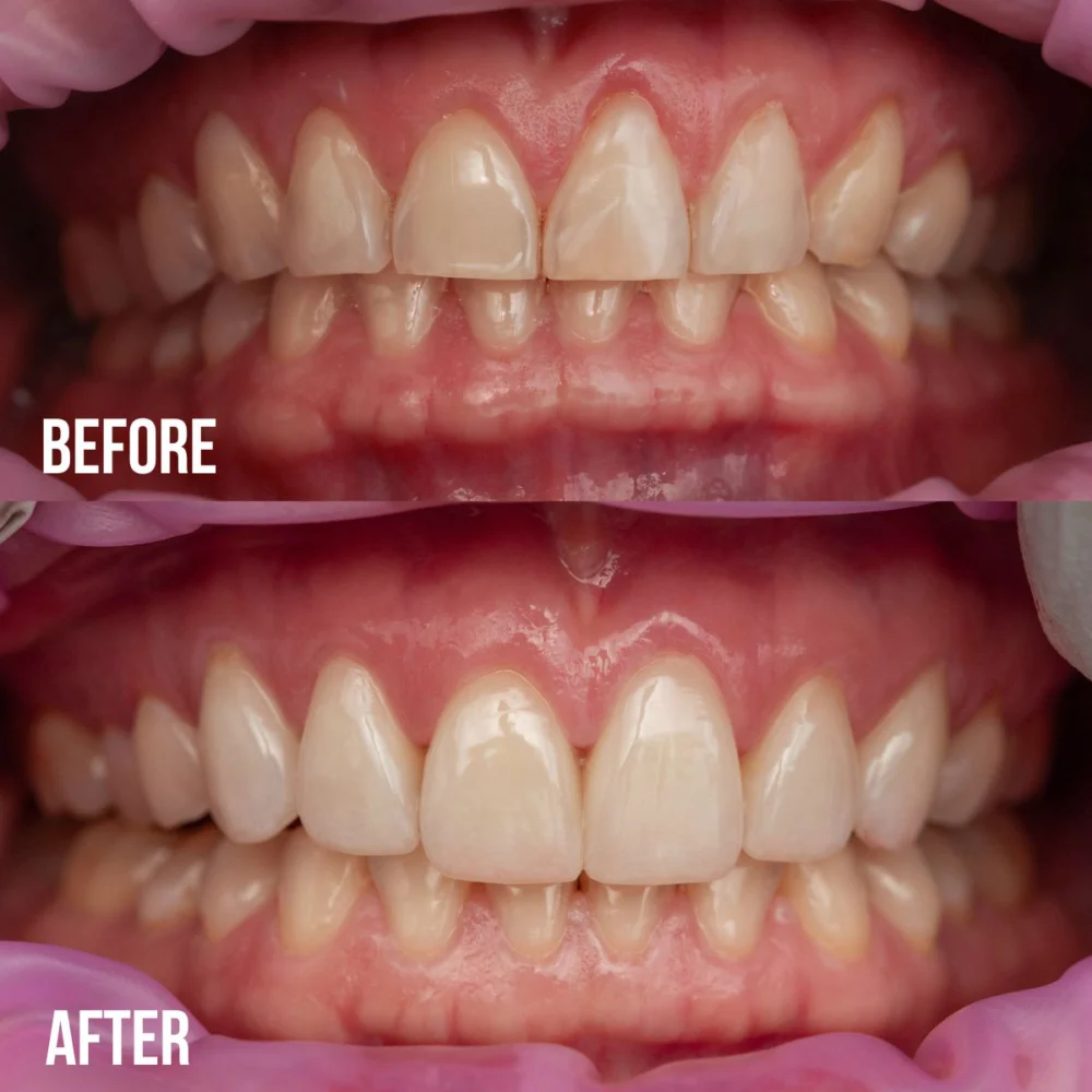 Porcelain Veneers Before And After
