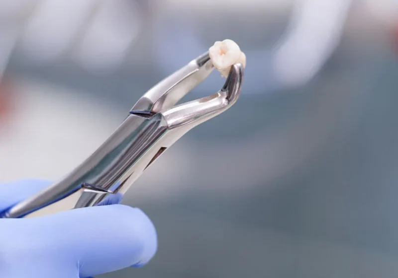 Tooth Extraction