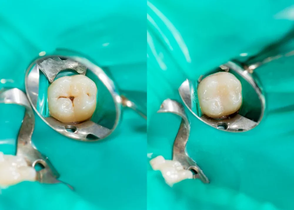 dental fillings before and after
