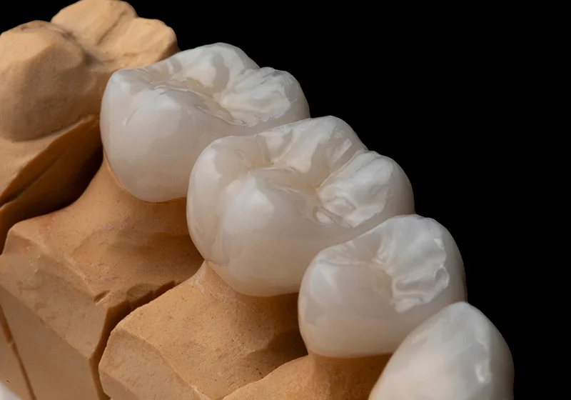 Dental Crowns Case By Dr. Tan Khuu