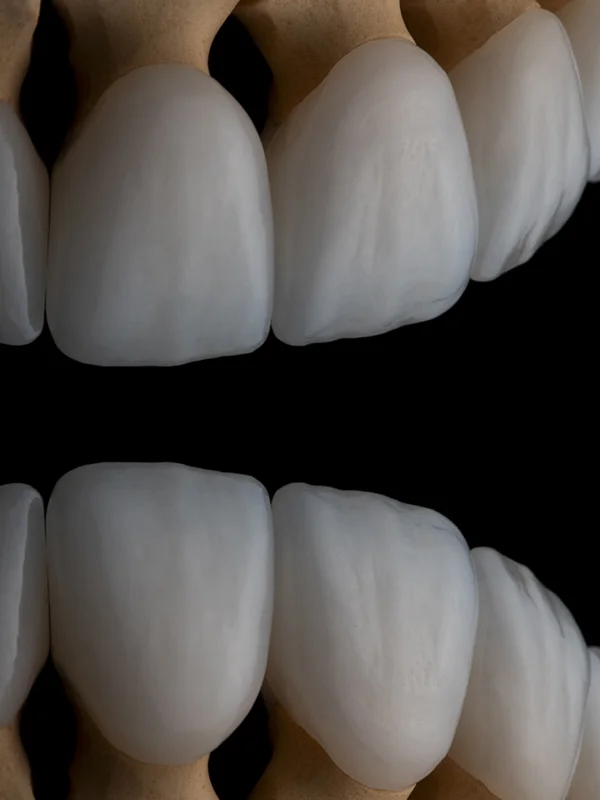 Dr. Tan Khuu Porcelain Veneers Case Close Up