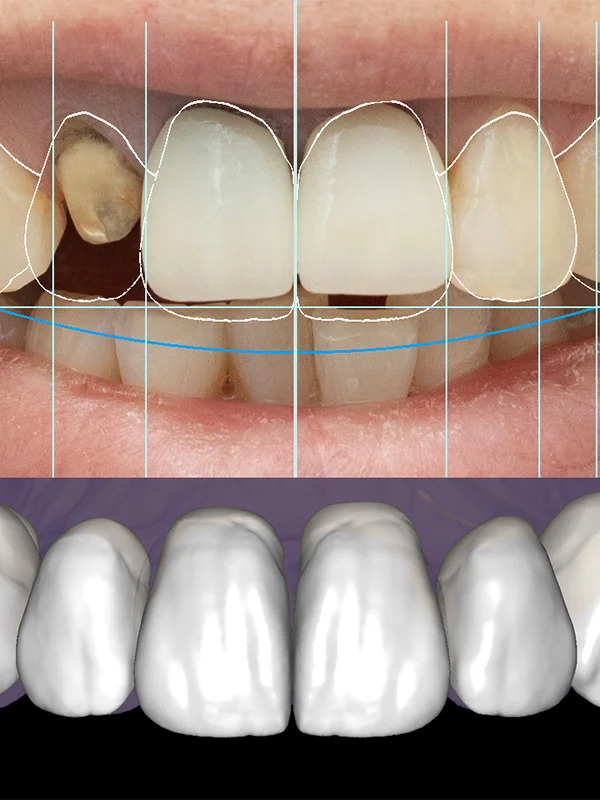Full Smile Makeover Case By Dr. Tan Khuu