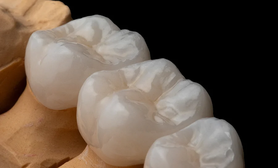 Garden Grove Dental Crowns Case By Tan Khuu DDS