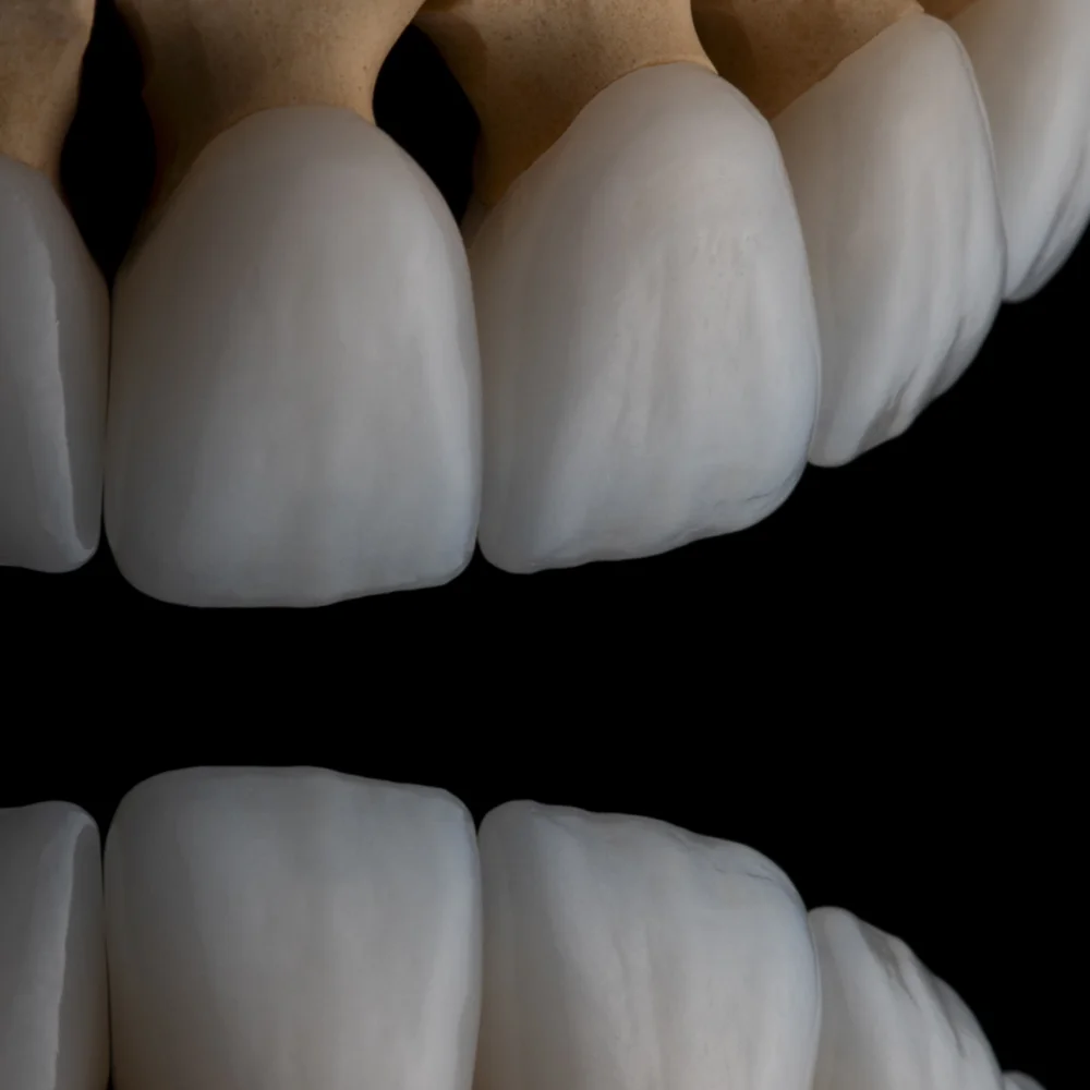 Garden Grove Porcelain Veneers Case By Dr. Tan Khuu, DDS